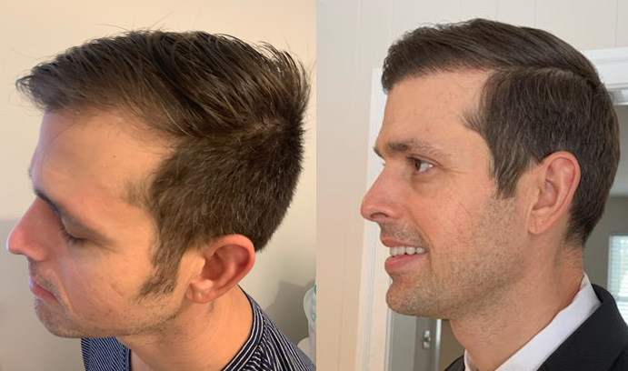 Is Your Hair Loss a Good Candidate for Hair Transplant Surgery? post thumbnail image
