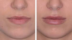 Common Techniques Used for Lip Fillers Santa Barbara post thumbnail image