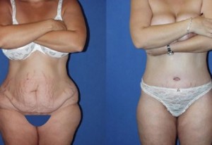 Abdominoplasty: Making the Right Choice for You in Miami post thumbnail image