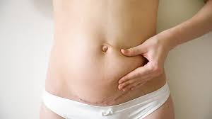Considering a Tummy Tuck? Discover Miami’s Top Surgeons post thumbnail image